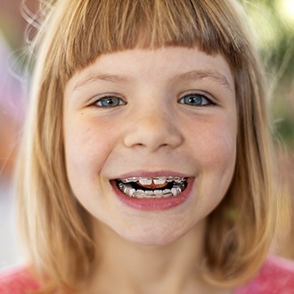 Smiling child with an orthodontic appliance