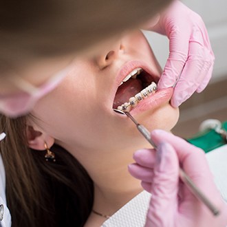 Milton orthodontist placing brackets on patient's teeth