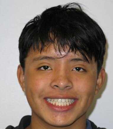 Teen with straight smile after orthodontics