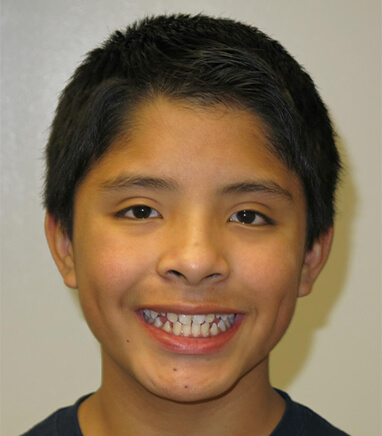 Child with crooked teeth before orthodontics