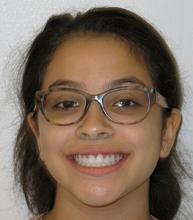 Young woman with aligned smilea fter orthodontics