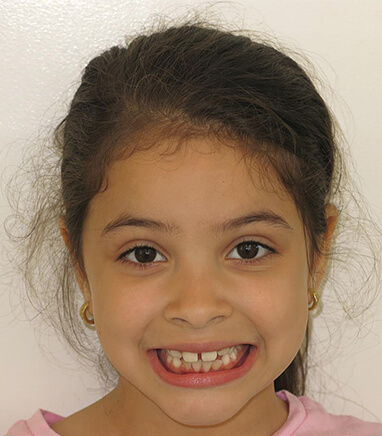 Girl with gaps between teeth before orthodontics