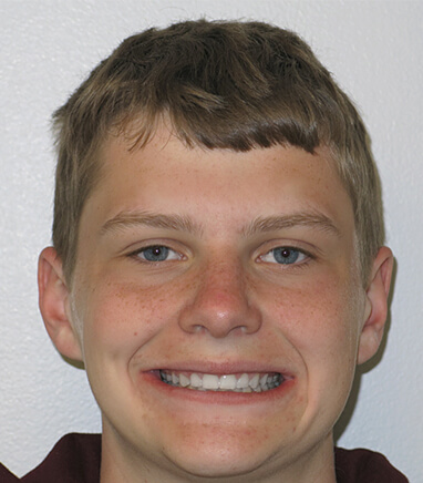 Young boy smiling after orthodontics