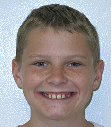 Young boy smiling before orthodontics