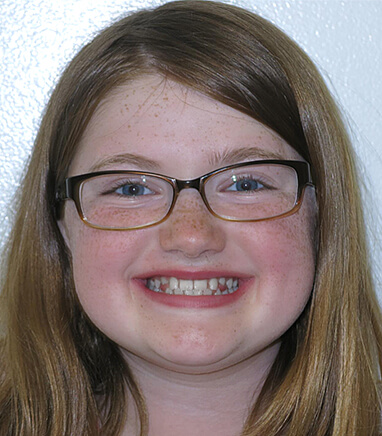 Young girl smiling before pediatric orthodontics