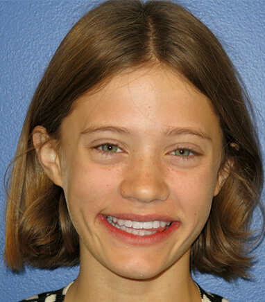 Preteen girl smiling after braces