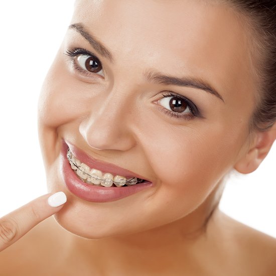 Woman with clear and ceramic braces pointing to her smile