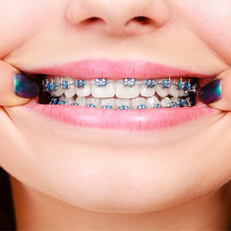 : a closeup of a smile with braces