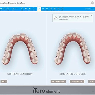 3 D smile images on chairside computer