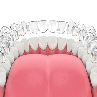 Illustration of Invisalign in Milton being placed over teeth