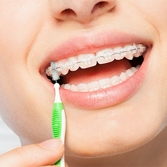 An up-close look at an individual using an interdental brush to properly clean between their teeth and underneath their arch wire