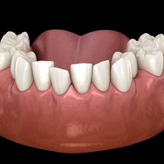 Diagram from Milton Orthodontist showing overcrowding teeth