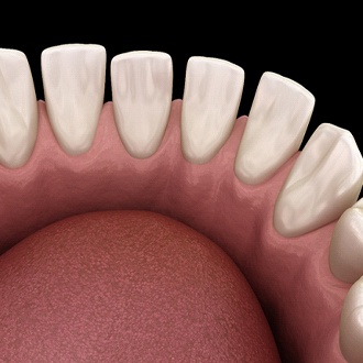 Diagram from Milton Orthodontist of gapped teeth in Milton