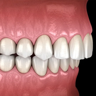 Diagram from Milton orthodontist showing overbite in Milton