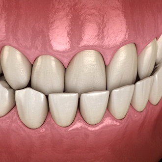 Diagram from Milton orthodontist showing underbite in Milton