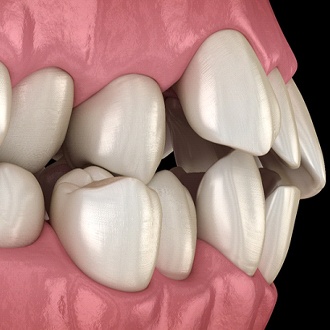 Diagram from Milton orthodontist showing crossbite in Milton