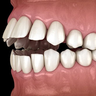 Diagram from Milton orthodontist showing open bite in Milton