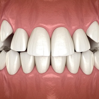 Diagram from Milton orthodontist of impacted canines in Milton