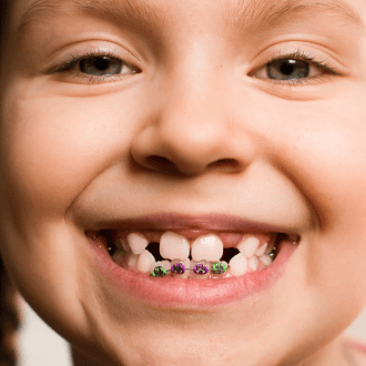 Closeup of child with pediatric orthodontics appliance