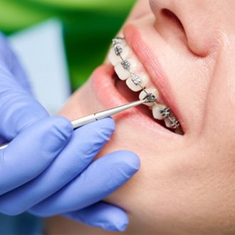 Orthodontist placing traditional braces on patient's teeth