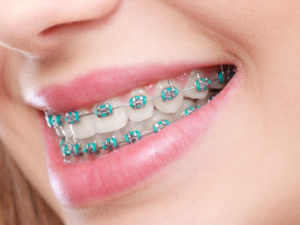 Closeup of patient with healthy smile and clean braces